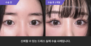 자연유착 + 눈매교정 재수술