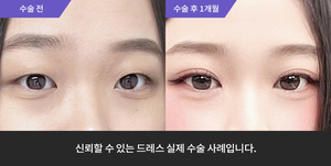 자연유착 + 눈매교정 + 앞트임 + 윗트임
