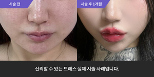 입술필러, + 울쎄라 + 사각턱보톡스 + 포텐자 + 엑소좀