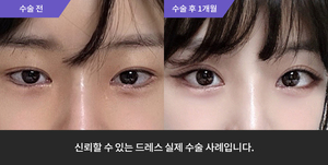 자연유착 재수술 + 눈매교정 + 듀얼트임 + 윗트임