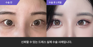 자연유착 + 눈매교정