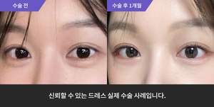 듀얼트임 재수술