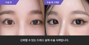 자연유착재수술 + 눈매교정 + 윗트임