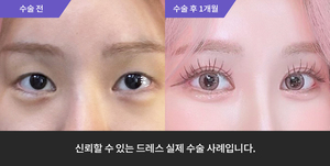 자연유착 재수술 + 눈매교정 + 듀얼트임