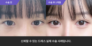 자연유착 재수술 + 듀얼트임