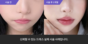 코필러 + 입술필러