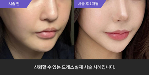 암살주사