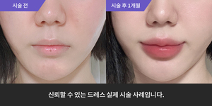 슈링크 + 입술필러
