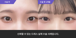 자연유착재수술 + 눈매교정 + 사선트임