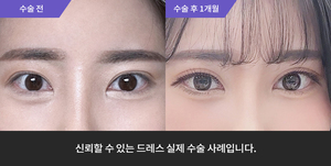 자연유착 + 눈매교정 재수술 + 윗트임