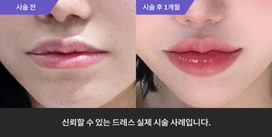 입술필러