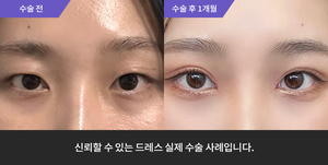 자연유착 + 눈매교정 + 사선트임
