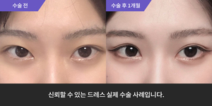 자연유착 + 눈매교정