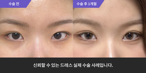 자연유착재수술 + 앞트임재수술