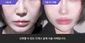 티타늄 + 풀페이스필러