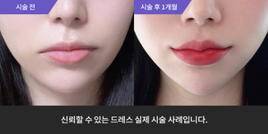 입술필러 + 턱필러