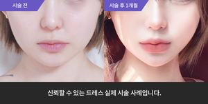 입술필러 + 티타늄