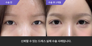 자연유착재수술 + 비절개눈매교정 