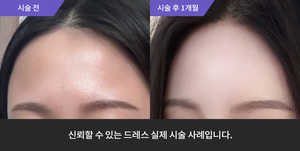 이마필러