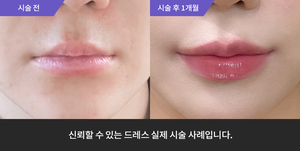 입술필러