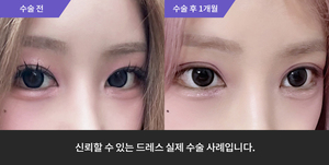 자연유착재수술 + 눈매교정재수술