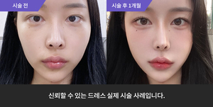 옆볼필러 + 관자필러 + 마리오네트필러 + 윤곽주사