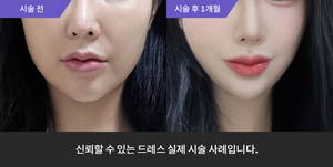 옆볼필러 + 사각턱보톡스
