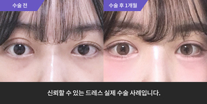 자연유착재수술 + 눈매교정재수술