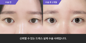 자연유착재수술 + 눈매교정