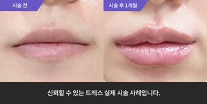 입술필러