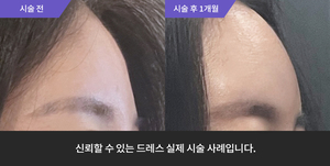 이마필러