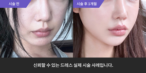 울쎄라 + 스킨바이브