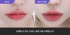 입술필러