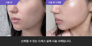 풀페이스필러