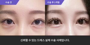 자연유착 재수술 + 뒷트임 + 밑트임