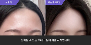 이마필러