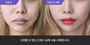 포텐자 + 입술필러