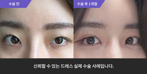 자연유착 + 눈매교정재수술 +  앞트임 + 윗트임 + 뒤트임 + 밑트임