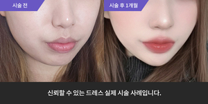 티타늄