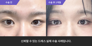자연유착 + 뒤트임 + 밑트임