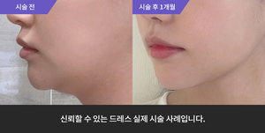울쎄라 + 암살주사 + 팔자필러