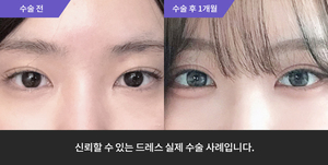 자연유착재수술 + 눈매교정 + 뒤트임 + 밑트임