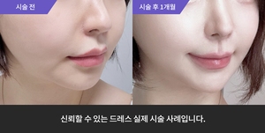 티타늄리프팅 + 리쥬란힐러