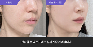 티타늄 + 엑소좀 + 리쥬란힐러