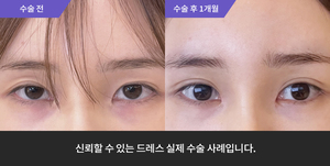 자연유착재수술 + 앞트임 + 윗트임