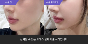 풀페이스필러 + 눈밑필러
