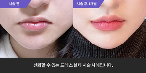 입술필러
