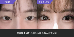 자연유착 + 눈매교정