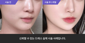 코필러 + 암살주사
