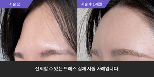 이마필러